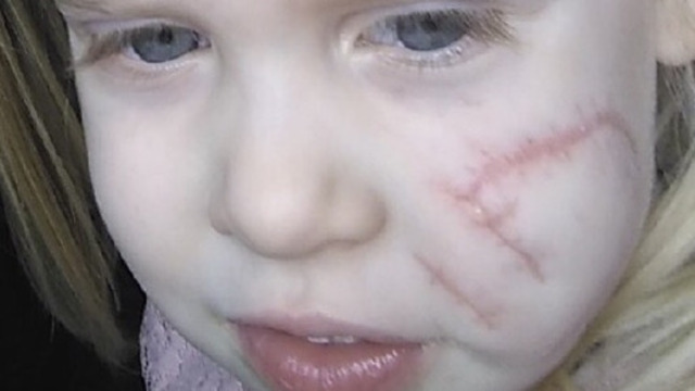 Родные покалеченной бездомным псом девочки из Балтийска будут судиться с региональными властями
