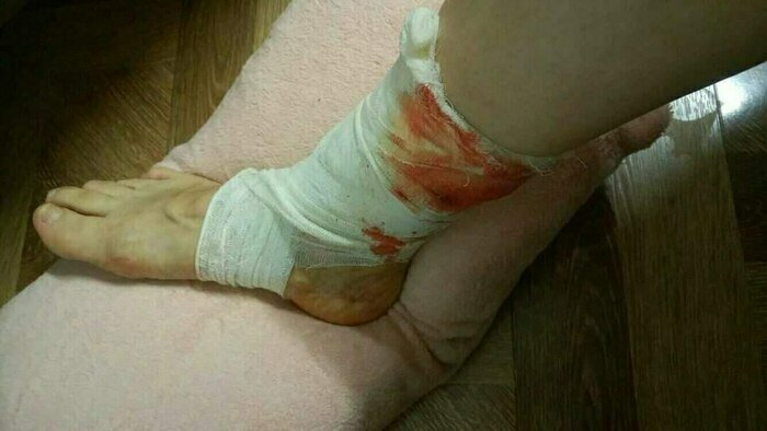 «Я орала от боли на весь пляж»: на променаде в Отрадном собака охраняющая стройку, прокусила ногу калининградке   - Новости Калининграда | Фото: пострадавшая Юлия