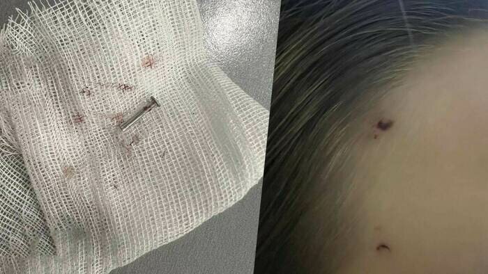 Гвоздь вошёл шляпкой под кожу на глубину около 5 мм | Фото предоставила Елена