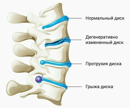 Колоссальный опыт восстановления грыж и протрузий в позвоночнике без операций - Новости Калининграда