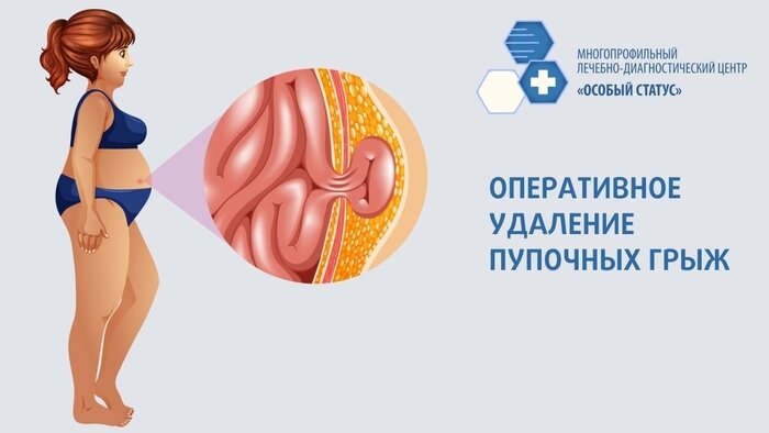 Хирургическое лечение грыж: когда операция — необходимость, а не рекомендация - Новости Калининграда