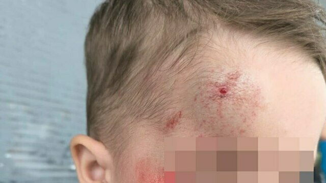 «Что я пережила,  не пожелаешь и врагу!» - подросток на самокате сбил на тротуаре трёхлетку