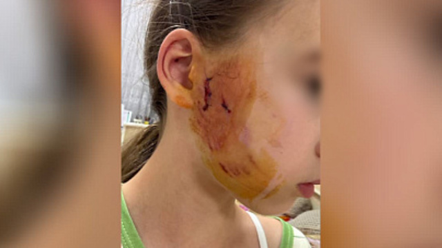 Владельцы пса, искусавшего 11-летнюю калининградку, готовы компенсировать вред и корят себя за случившееся  