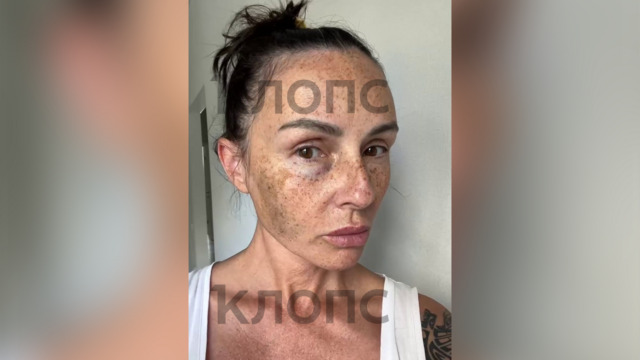 В Зеленоградске туристка получила кулаком в лицо от сотрудника кафе, который выгонял пережидавших дождь людей   
