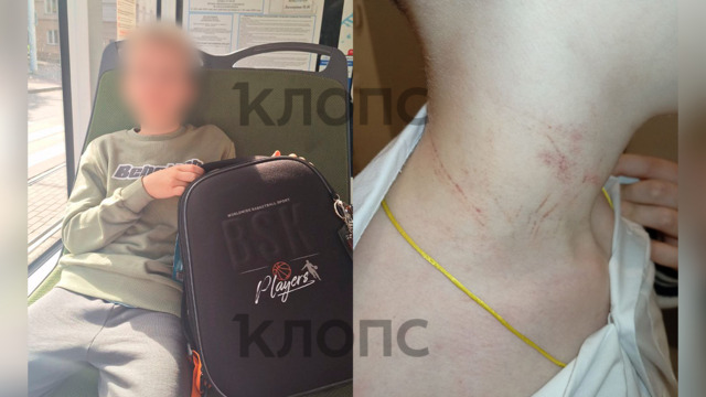 В Калининграде одноклассник регулярно избивает 10-летнего мальчика и показывает на нём удушающие приёмы
