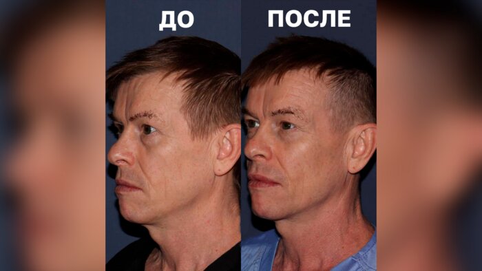 Эффект после процедуры полимолочной кислоты и векторного лифтинга | Личный архив Анны Смольяновой