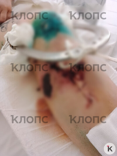 Женщина более полугода передвигалась на инвалидной коляске  | Фото: предоставила Светлана