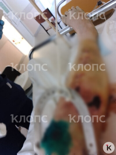 Женщина более полугода передвигалась на инвалидной коляске  | Фото: предоставила Светлана