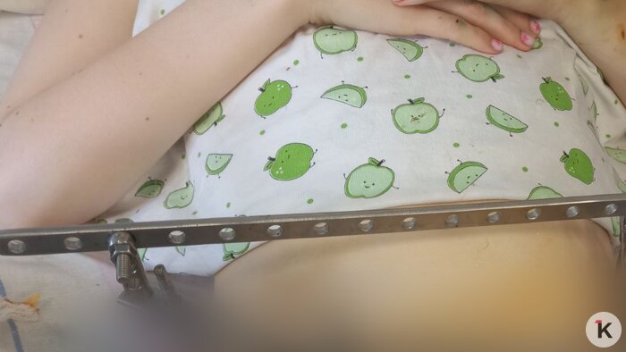 Дочь два месяца лежала с конструкцией, но  кости не срослись  | Фото: предоставила Елена 