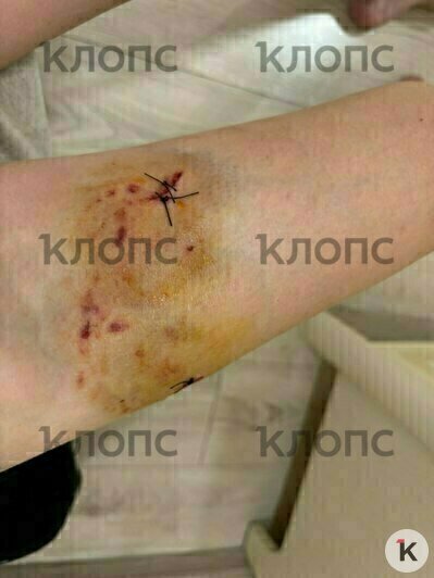 Сорвался с поводка и вцепился зубами: в центре Калининграда пёс набросился на 11-летнюю девочку (фото, видео)   - Новости Калининграда | Фото: «Клопс»
