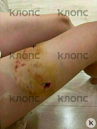 Сорвался с поводка и вцепился зубами: в центре Калининграда пёс набросился на 11-летнюю девочку (фото, видео)   - Новости Калининграда | Фото: «Клопс»