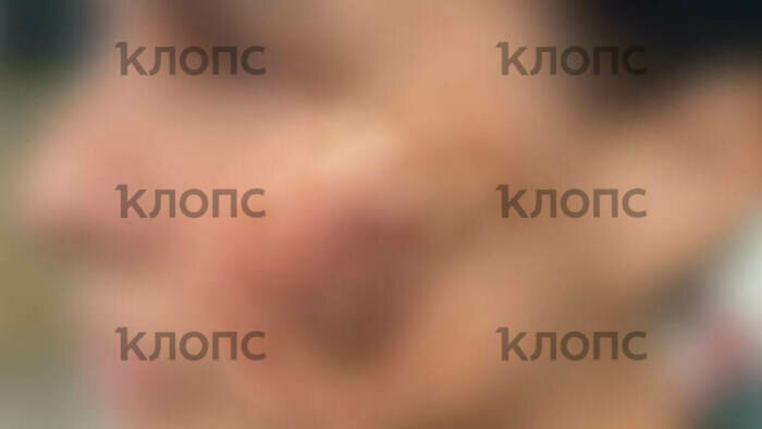 На лице женщины после удара остался огромный синяк | Фото: предоставила Екатерина