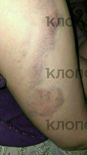 В феврале сосед избил в подъезде женщину палкой и сломал лодыжку  | Фото: предоставила Елена 