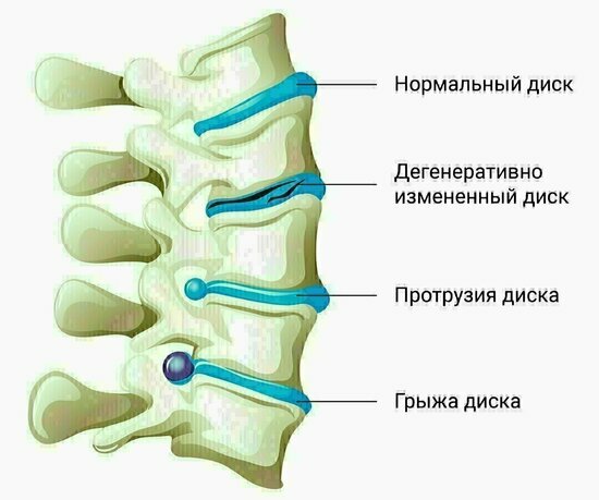 Колоссальный опыт восстановления грыж и протрузий в позвоночнике без операций - Новости Калининграда