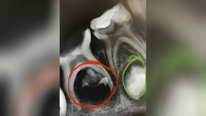 Наглядный пример, когда инфекция разрушила зачаток постоянного зуба | Фото: личный архив Станислава Мухина
