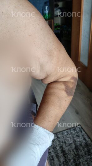 У женщины синяки на теле, на руке гипс. Мария два месяца носит корсет. | Фото: Александр