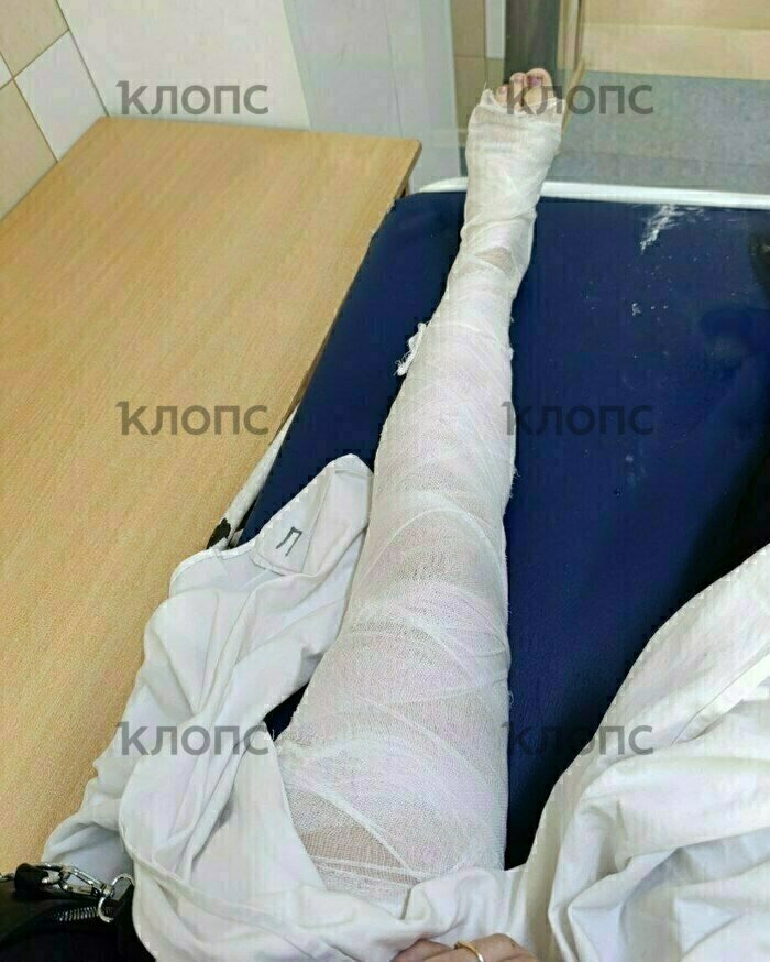 Один из диагнозов: перелом малой берцовой кости  | Фото: предоставил Николай 