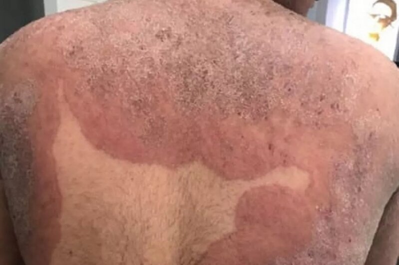 В Великобритании распространяется устойчивый к лекарствам грибок, поражающий паховую область и ягодицы - Новости Калининграда | Фото: MDPI 