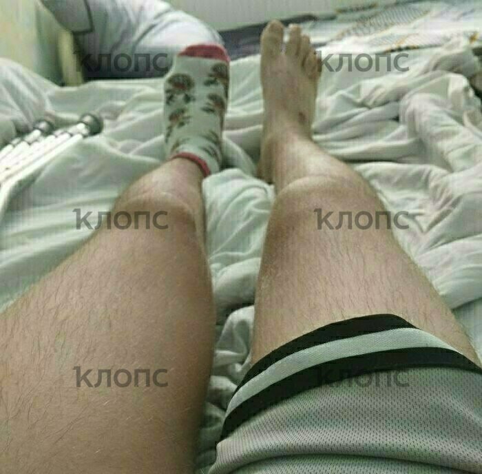 Правая нога значительно искривлена и деформирована  | Фото: предоставила мама Алексея