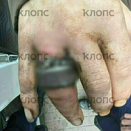 Пилили под наркозом: в Калининграде спасатели освободили палец мужчины от железных колец (видео) - Новости Калининграда | Фото: ГО и ЧС Калининграда