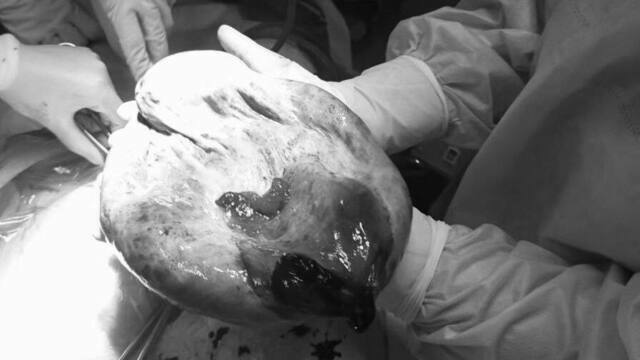 У 13-летней пациентки удалили огромную кисту яичника на три литра жидкости