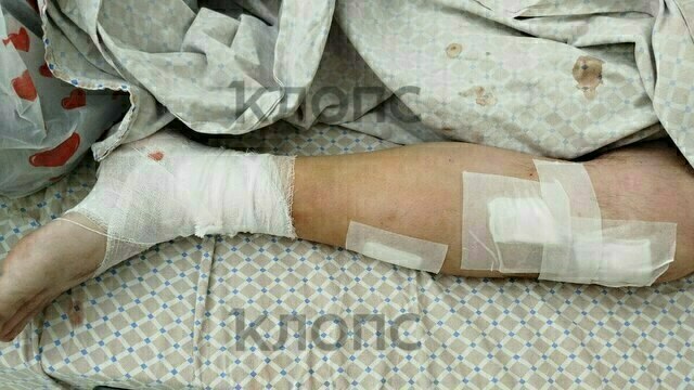 Избитый под Калининградом многодетный отец почти год ждёт решения следствия и пытается восстановить искалеченную ногу   