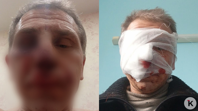 Едва не откусил нос: в Калининграде питбуль набросился на знакомого хозяйки и разорвал ему лицо (фото)   