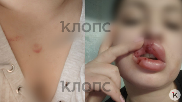 Держал пистолет у лица и кричал, что убьёт: 31-летнюю калининградку избили и едва не застрелили в гостях у подруги (фото)