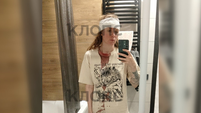 «Я думала, что умру»: туристка из Самары упала с лестницы на променаде в Зеленоградске и получила травмы (фото)   