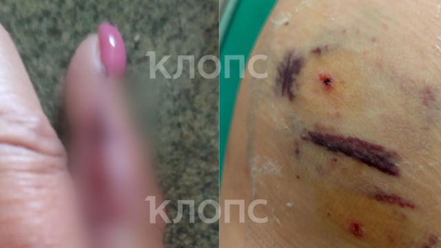 «Мне кричали, не подходите, но было поздно»: одна собака покусала троих калининградцев за час (фото)  