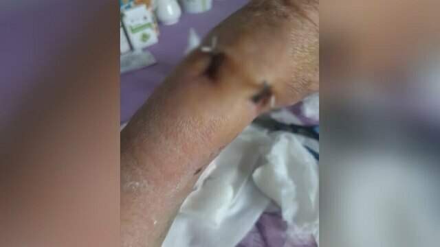 «Я теперь боюсь ходить по улицам»: 66-летняя калининградка получила тяжёлый перелом после столкновения с самокатчицей  