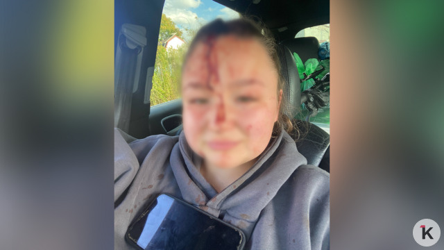 На меня набросились вдвоём: 22-летней калининградке пробили голову гаечным ключом во время ссоры родственников 