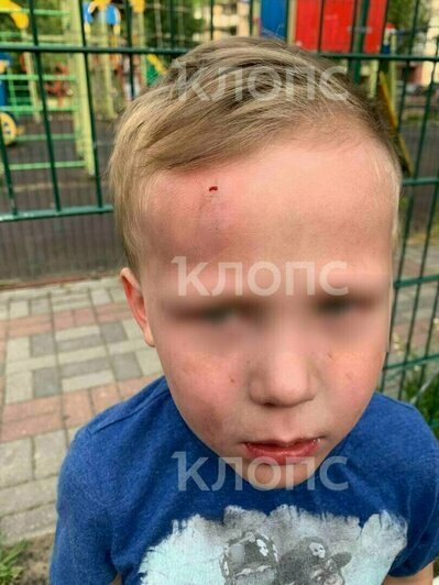 Пострадавший ребёнок в июне 2024 года | Фото: Татьяна Завьялова