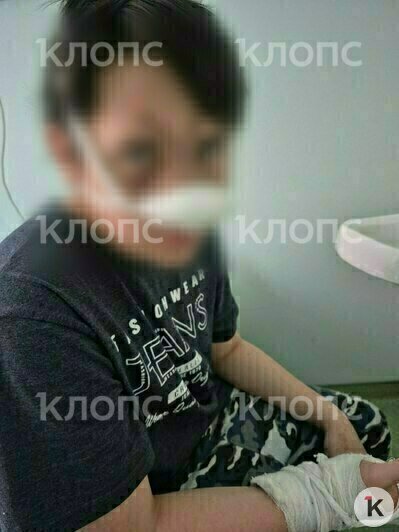 Туалет был залит кровью, у подростка перелом носа со смещением и руки  | Фото: предоставила Татьяна 