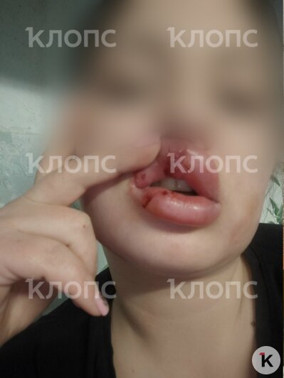 У девушки серьёзные травмы лица  | Фото: предоставила потерпевшая 