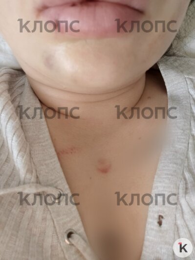 На груди девушки отчётливый отпечаток от дула пистолета, это зафиксировано в результатах СМЭ | Фото: предоставила пострадавшая 