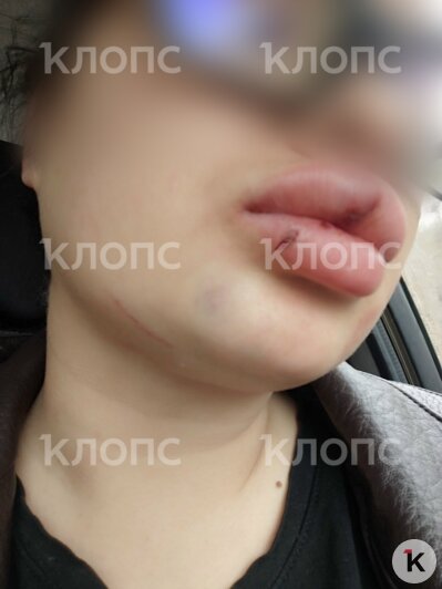 На груди девушки отчётливый отпечаток от дула пистолета, это зафиксировано в результатах СМЭ | Фото: предоставила пострадавшая 