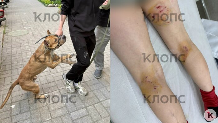 У Платона раны гораздо серьёзнее — намордник не помешал собаке нанести ребёнку такие травмы | Фото: предоставила Виктория 