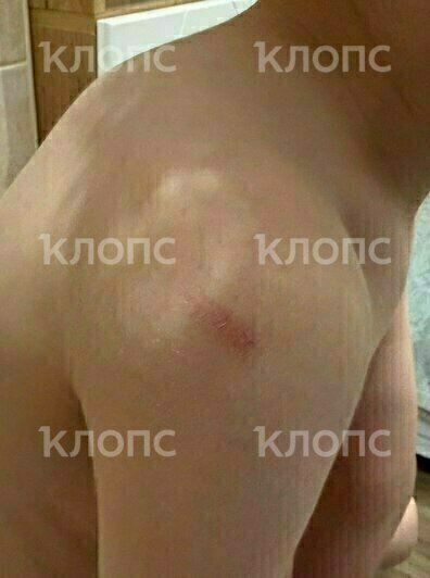 Синяки и ссадины начали появляться у сына с переходом в новую группу | Фото предоставила Марина 