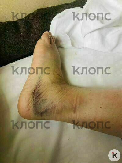 После ДТП ей диагностировали растяжение, она с трудом наступает на ногу | Фото: предоставила Екатерина 