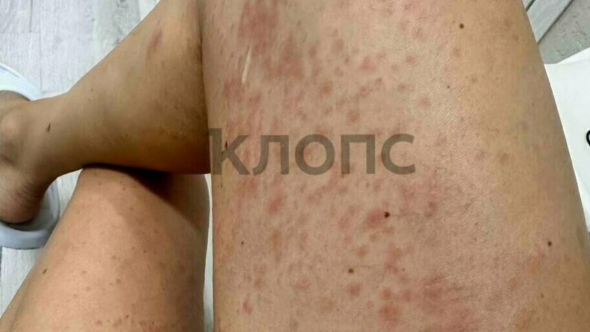 В минздраве Калининградской области рассказали, как защитить кожу от гусениц, которые обитают не только на Куршской косе - Новости Калининграда | Фото пострадавшей