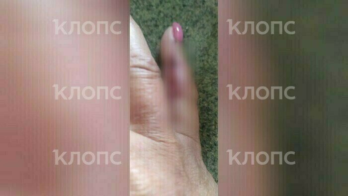 «Мне кричали, не подходите, но было поздно»: одна собака покусала троих калининградцев за час (фото)   - Новости Калининграда | Фото: предоставила Марина