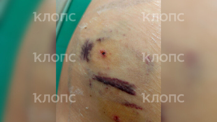 «Мне кричали, не подходите, но было поздно»: одна собака покусала троих калининградцев за час (фото)   - Новости Калининграда | Фото: предоставила Ольга