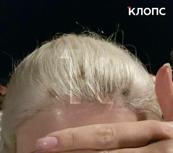 В Зеленоградске во время салюта искры полетели в толпу: женщине прожгло куртку и опалило волосы (фото, видео) - Новости Калининграда | Фото: очевидица