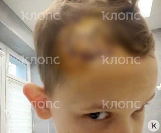 На голове ребёнка большая скальпированная рана, ему наложили около 15 швов  | Фото: предоставила мама мальчика 