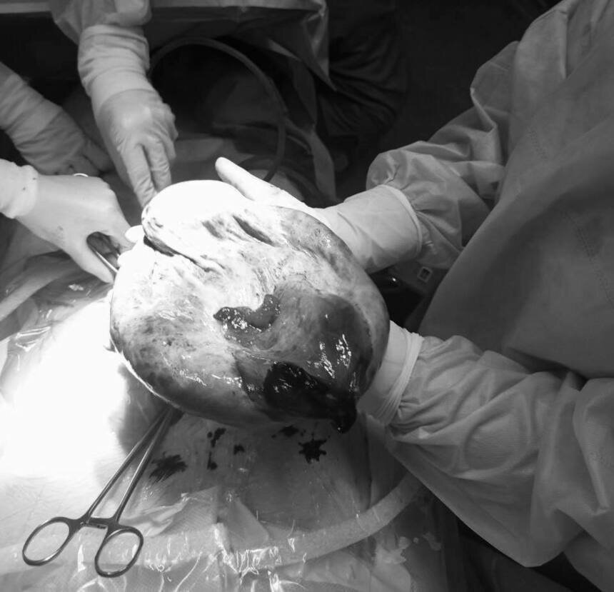 Операция по удалению кисты. | Фото: Региональный перинатальный центр