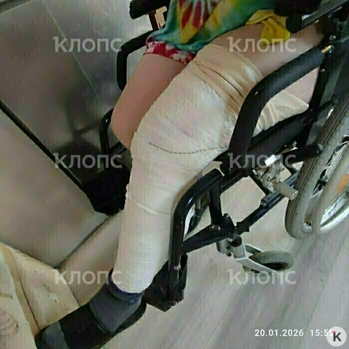 После потасовки в приёмном покое нога женщины в гипсе  | Фото: предоставила мама мальчика