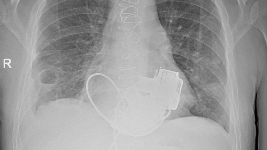Пульса нет вообще, а вместо сердца — два пламенных мотора: в России впервые пациенту имплантировали оба желудочка - Новости Калининграда | Фото: Комитет по здравоохранению Санкт-Петербурга
