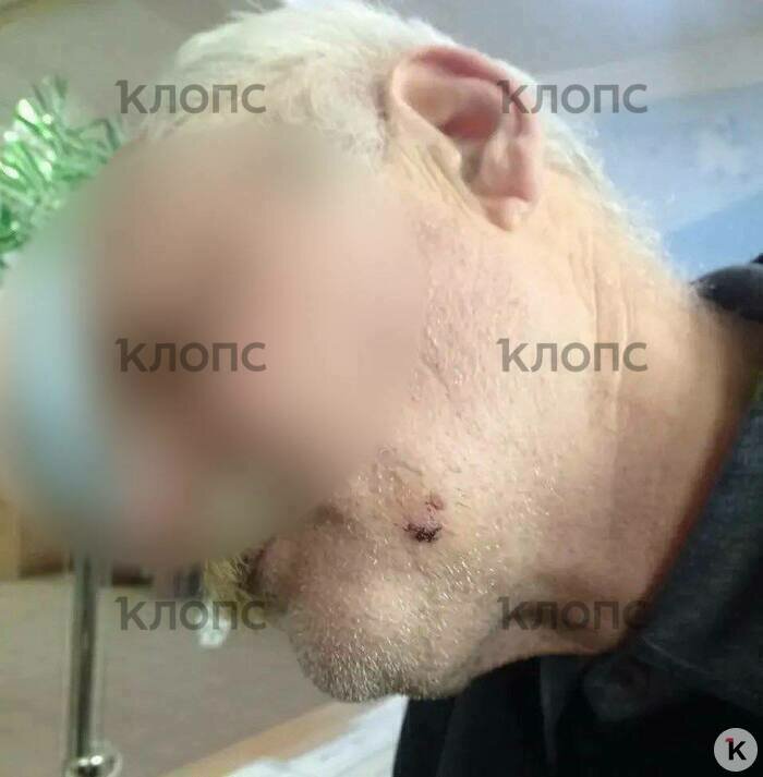 Охранника учреждения женщина укусила за лицо | Фото: предоставили в ДОБ