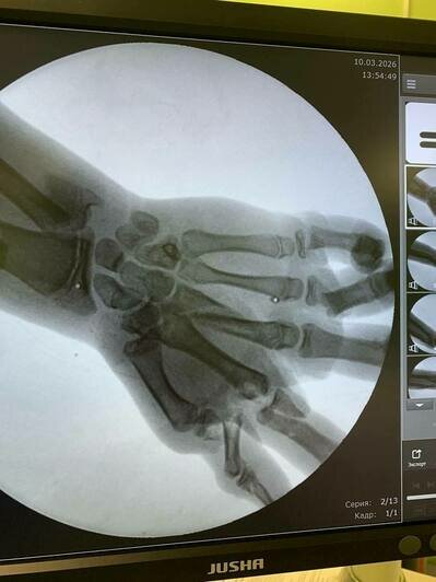 Распилил снаряд болгаркой: калининградские врачи по частям собрали кисть подростку - Новости Калининграда | Фото: минздрав Калининградской области